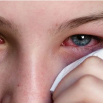Pink Eye