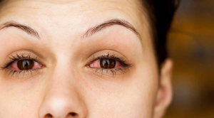 Pink Eye
